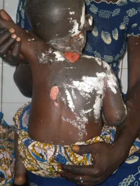 brulûre à l'eau bouillante récouverte de dentifrice 